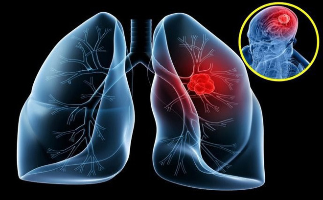 5 dấu hiệu sớm của ung thư phổi bạn cần biết